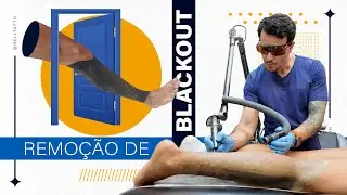 Atravessou a fronteira para apagar o Blackout com Pico Laser | Remoção de Tatuagem Satisfatória