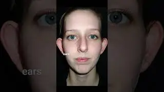 Otoplasty: Surgery for Protruding Ears #shorts