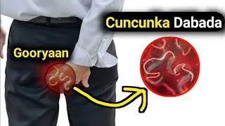 Gooryaanka daba cuncunka keena habeenkii ee Dira-diraha  cadcad ( Enterobius vermicularis ) 💊💊💊💊💊