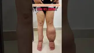Lymphedema Successful Treatment | Physiotherapy Recovery Journey 💪 #shortsfeed #lymphedema