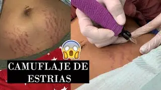 CAMUFLAJE DE ESTRIAS Mi experiencia, les muestro el proceso! - Ydelays