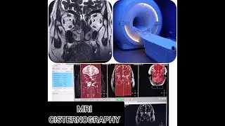 MRI CISTERNOGRAPHY II PLANNING II POSITIONING II SEQUENCE DETAILS
