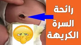 اسباب رائحة السرة الكريهة عند المولود تعرفي علي كيفية العناية بالسرة