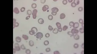 HEMEFLIX: Hypochromia and Howell Jolly Bodies