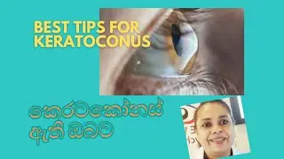 BEST OPTIONS- KERATOCONUS -කෙරටකෝනස් ඇති ඔබට