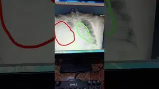 #effusion #pleural #pleuraleffusion #mediastinal #shift