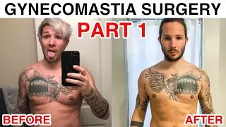 Gynecomastia Surgery Q & A - Part 1 | My Gynecomastia Surgery Recovery