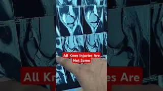 All Knee Injuries Are Not Same.. Dr Sai Chandra