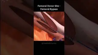 Femoral Bypass !! Femoral Donor Site - 1 #shorts #shortsvideo