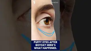 Part Two - Botox and Puffy Eyes? Here's What Went Wrong | Anatomy of Aesthetics