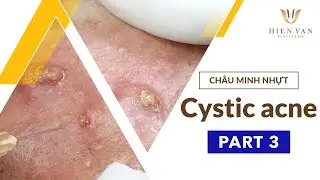 Điều Trị Mụn Hiệu Quả, Uy T&iacute;n Nhất TPHCM Tại Hiền V&acirc;n Spa I Ch&acirc;u Minh Nhựt I Part 3 I 452