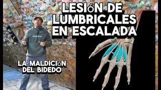 Lesión de lumbricales en escalada - Cuidado con lo bidedos