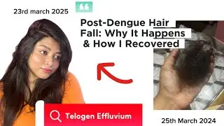 Post-Dengue Hair Fall? Here&rsquo;s What Helped Me Recover!