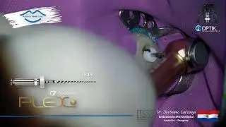 Safety Glide Path with Plex V 15 .03 & HyFlex EDM #20 using T - Mode.
