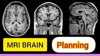 MRI BRAIN PLANNING EXPLAINED | SIEMENS MRI |