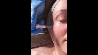 Hillan Mikroneulaus - BTB13 Micro-Meso Therapy