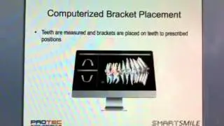 Indirect bracketing