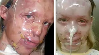 Dark Photos Of Disfigured Celebrities After Botched Surgery