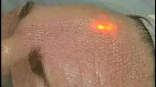 ActiveFX Procedure (Kenkel)