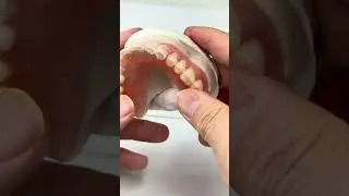 Utilized remaining teeth!