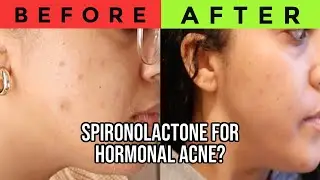 My 1 Month Experience on SPIRONOLACTONE for HORMONAL ACNE (BEFORE + AFTER) & skincare routine