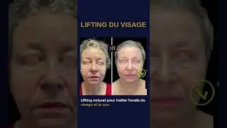 Avant apr&egrave;s lifting du visage et du cou .