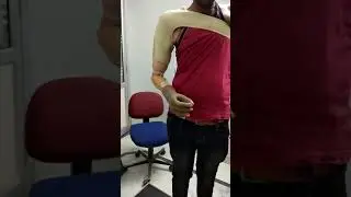 Above Elbow Myo Electric Prosthesis by Foot Care Jaipur (Artificial Limb Cinic Since 1998)