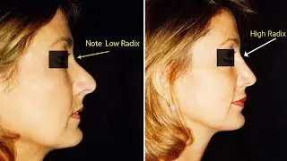 Why Your Side Profile Looks Weak (Radix Issue)