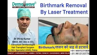 Birthmark Removal By Laser | Dermawave Skin Clinic Patna | Jammu | Panipat | Kurukshetra - Dr Dhiraj