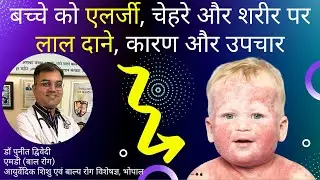 बच्चे को ऐलर्जी, चेहरे और शरीर पर लाल दाने, कारण और उपचार | डॉ पुनीत द्विवेदी