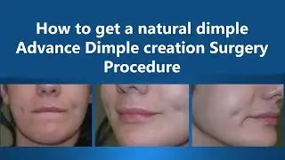 How to Get Instant Dimple | Advance Dimple Creation Surgery | The Esthetic Clinics, India