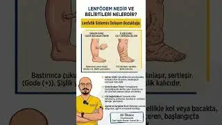 Lenf&ouml;dem nedir ve Belirtileri nelerdir? #rehabilitasyon #antalya #fizyoterapist