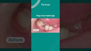Jadi masih ragu buat implan gigi?😌 implan di TANAM aja!🥰 #implangigi #implangigitermurah