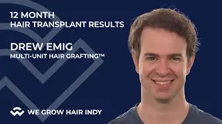 Hair Transplant Before & After - 12 Month Results