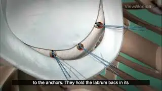 Shoulder Labrum Repair Process Explained 💪