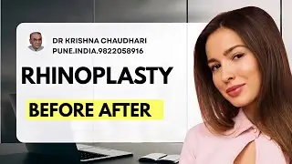 Chin Implant in Pune: Get Your Dream Profile in 1 Surgery! 😍