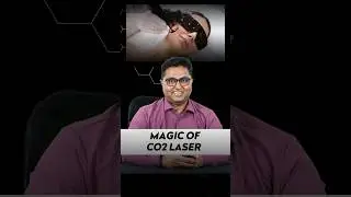 Magic of CO2 Laser - Scar Treatment - Dr.Karthik Ram - Chennai Plastic Surgery