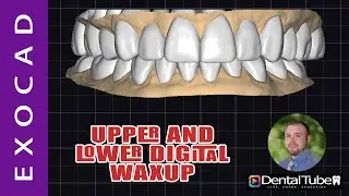 Exocad 3.2 Upper and Lower Digital Waxup