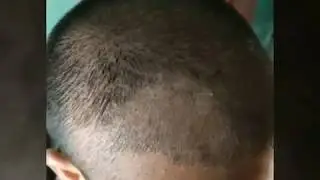 Hair transplant clot remove day to 1 month complete (Adorn clinic ahmedabad)