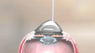 Topography Guided PRK with Simultaneous Collagen Cross Linking