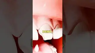 R&eacute;parer un bout de dent cass&eacute; 😳