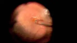 Epiretinal Membrane Peeling