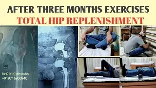 AFTER THREE MONTHS EXERCISES TOTAL HIP REPLACEMENT (THR) MIS TECHNIQUES