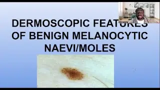 DERMOSCOPIC APPEARANCE OF BENIGN MELANOCYTIC NAEVI/MOLES