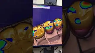 (работа была полностью согласована со всеми) #dentist #shorts