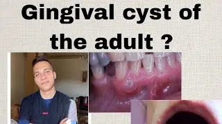 Gingival Cyst of the adult شرح