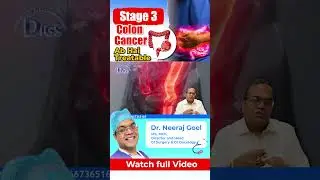What is the Treatment of stage 3 colon cancer? कैसे होता है स्टेज 3 कोलन कैंसर का इलाज?