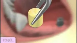 Dental Implants Guide | La Mesa Dentist