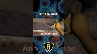 The issue with PRP for annular tears #prp #lowbackpain