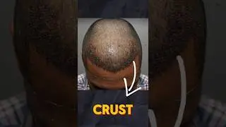 When to Remove Crust After Hair Transplant?  | Learn from the hair transplant surgeon | Dr Jangid